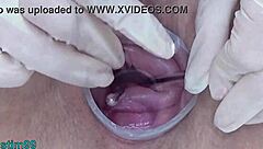 German Cervix Stretching With Catheter Inflation Uterus
